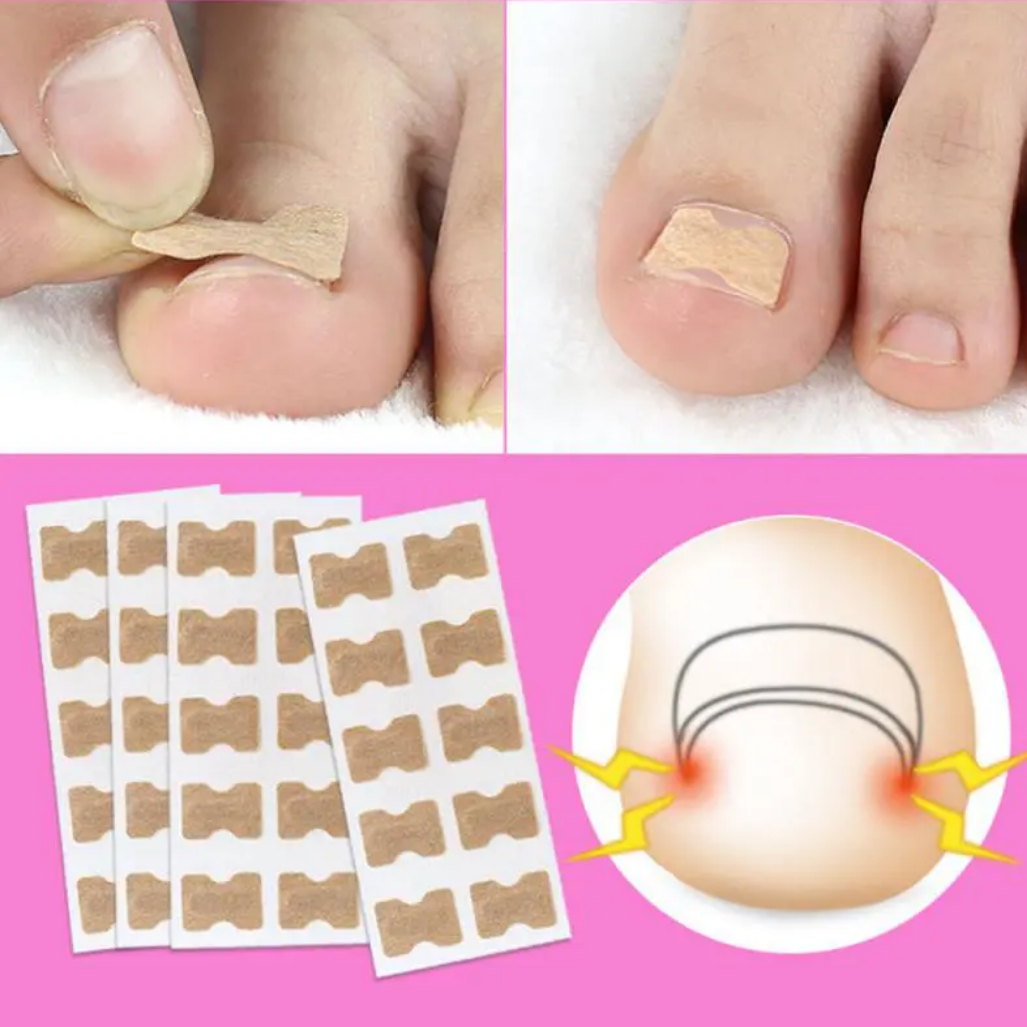 ToeCare™ Patch indolore pour ongles d'orteils (5+5 GRATUIT !)