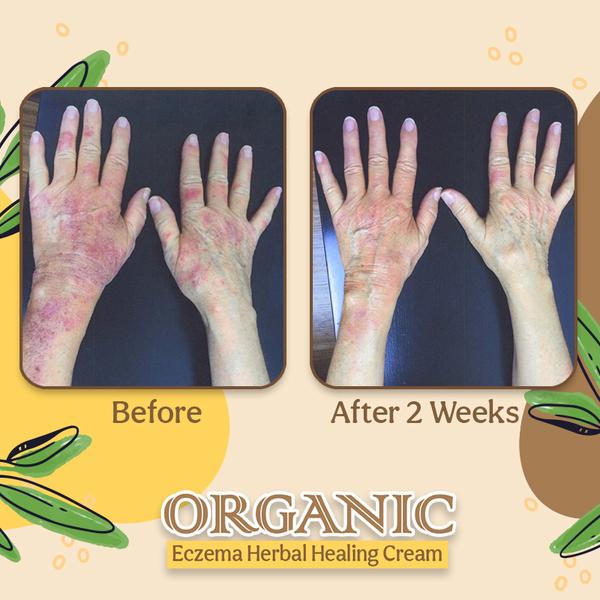 Organic Heal™ Crème de traitement à base de plantes pour l'eczéma biologique (1+1 GRATUIT !)